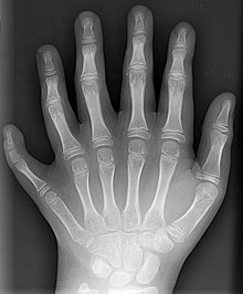 220px-Polydactyly_01_Lhand_AP.jpg